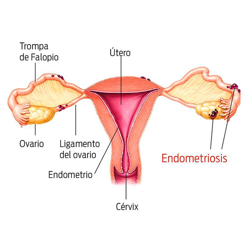 Endometriosis: cómo detectar la enfermedad y sus tratamientos